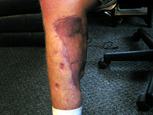 
This is Jim Vandenheuvel's right leg.  A roadside bomb ripped through his Humvee outside of Abu Graihb prison, leaving Jim with head and leg injuries.  (MPR Photo/Tim Post)