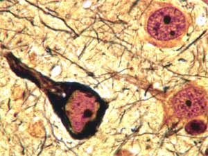 
This neurofibrillary tangle is from a 7-month old mouse brain. The picture shows a healthy neuron to the right and a damaged neuron to the left. The black coloration is
accumulations of toxic tau protein. University researchers now suspect that neurofibrillary tangles are a symptom of Alzheimer's, not a cause of the disease. (Photo courtesy of the University of Minnesota)