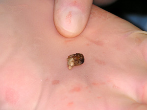 
Though small in size, a kidney stone is big enough to cause some serious problems. (MPR Photo/Lorna Benson)