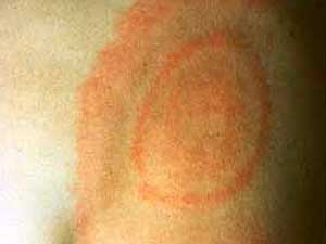 
The bullseye-shaped rash is a classic symptom of Lyme disease, which is spread by deer ticks. It can be treated successfully with antibiotics if detected early. (Photo courtesy of the Lyme Disease Foundation)